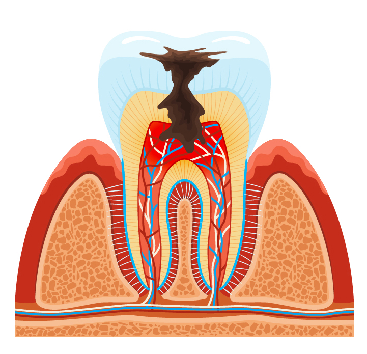 Воспаление Корня Зуба Фото - Mixyfotos.ru