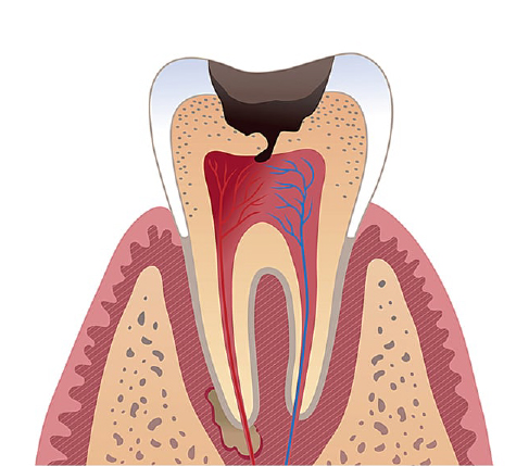лечение периодонтита зубов