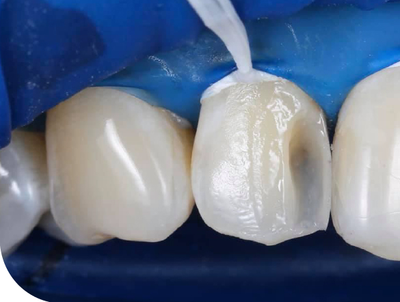 Композитные виниры