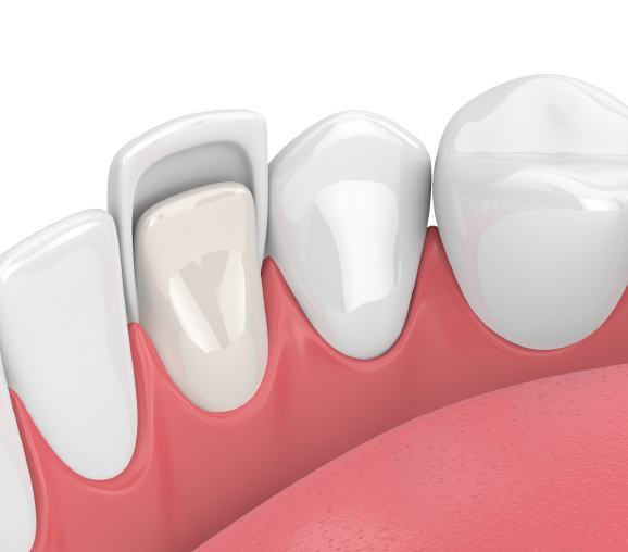 Композитные виниры