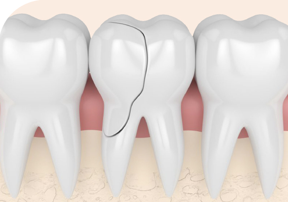 Эстетическая реставрация зубов